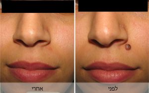 הסרת נקודות חן/שומות בלייזר